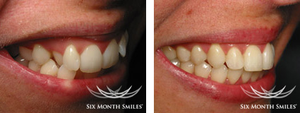 6 month smiles